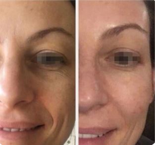 Resultaat na 2 sessies door m.pen van Mesoestetic