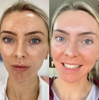 cosmelan after resultaat